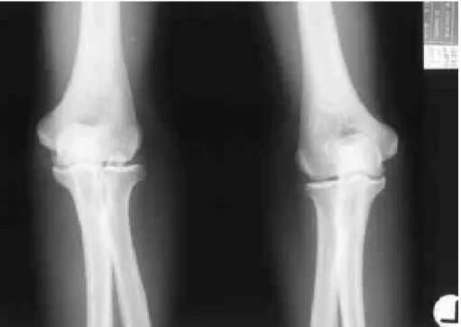 Fig. 1. Both elbow AP view shows loose body of right elbow joint. 