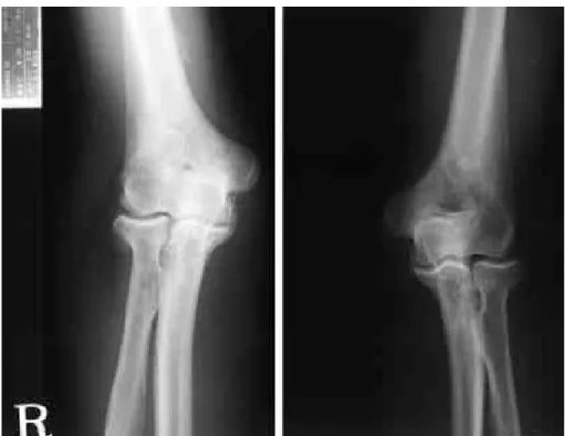 Fig. 3. Both elbow AP view shows degenerative spur and sclerotic bony lesion of right elbow joint.