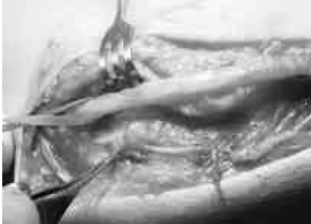 Fig. 4. A longitudinal incision was made over anterome- anterome-dial aspect of the elbow