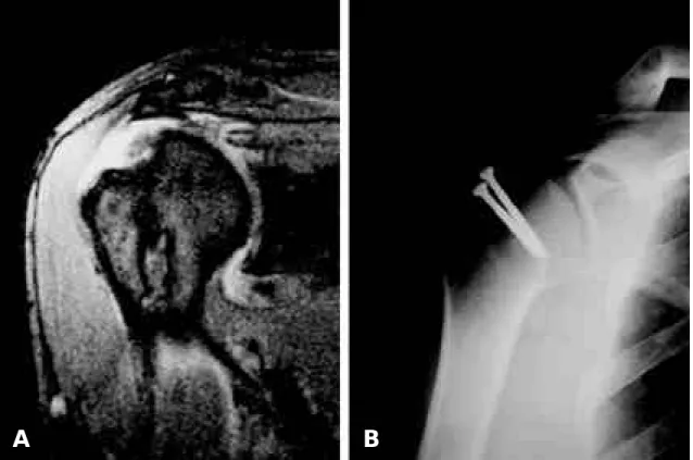 Fig. 2. (A) MRI showing complete rotator cuff tear and large Hill-Sachs lesion. (B) Plain radiograph shows that graft- graft-ed iliac bone was well unitgraft-ed.