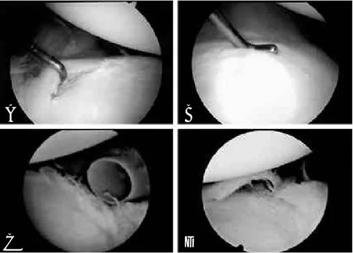 Fig. 2. Four type of labral lesion of the posteroinferior instability. (A) Type I: Incomplete detachment