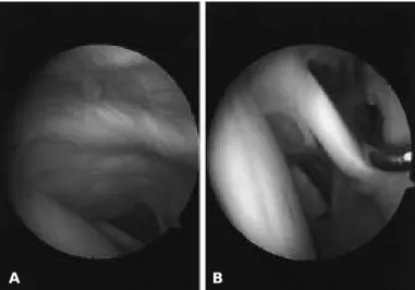 Fig. 2. (A) On arthroscopic examination, intraarticular portion of long head biceps tendon was concealed