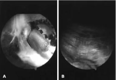 Fig. 4. Open partial scapulectomy of superomedial angle was performed. (5×4×3 cm)