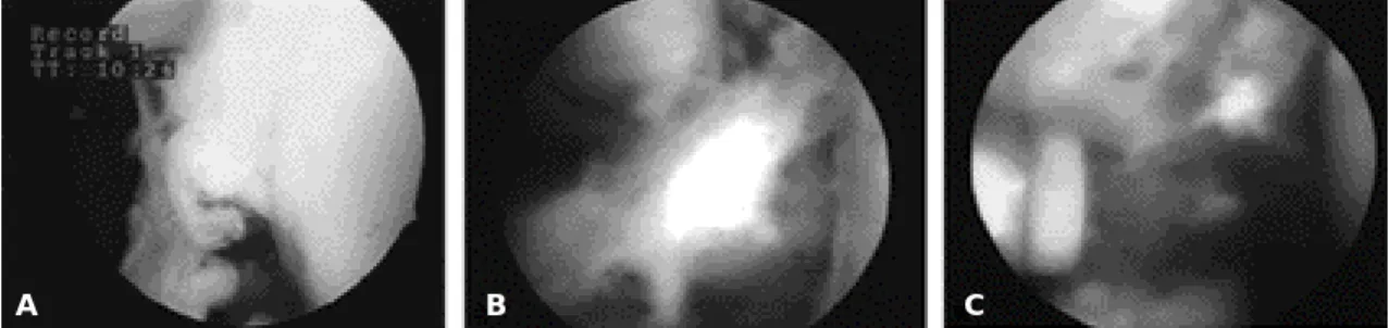 Fig. 4. At 6 months after arthroscopic removal of the rotator interval bridging scar adhesion, we could observe a full range of shoulder motion in the external rotation(A), abduction(B) and flexion(C).