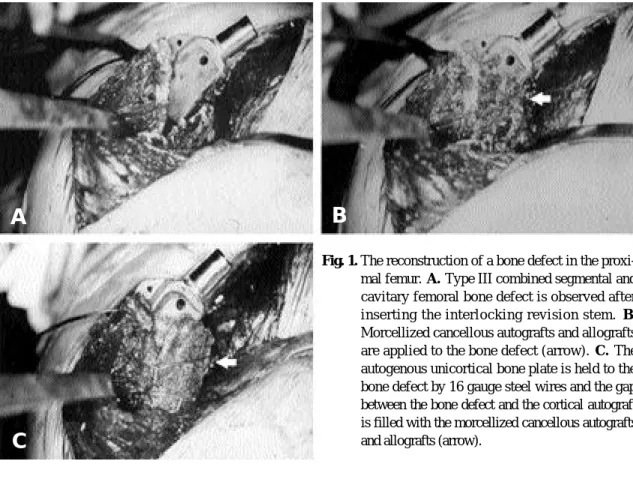 Fig. 1. The reconstruction of a bone defect in the proxi- proxi-mal femur.  A.  Type III combined segmental and cavitary femoral bone defect is observed after inserting the interlocking revision stem