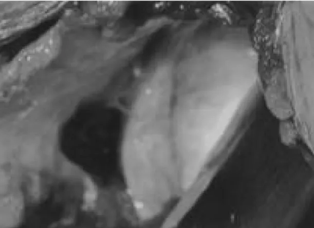Fig. 1. A large capsular tear is seen adjacent to the intact glenoid labrum.