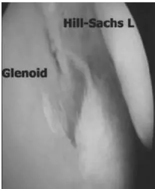 Fig. 5. Large bony Bankart lesion should be internally fixed if possible.