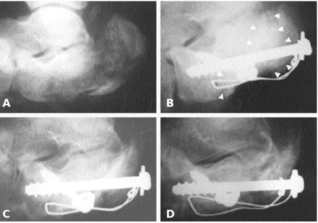 Fig. 1. Case of calcaneal osteomyelitis treated with debridement and delayed bone graft