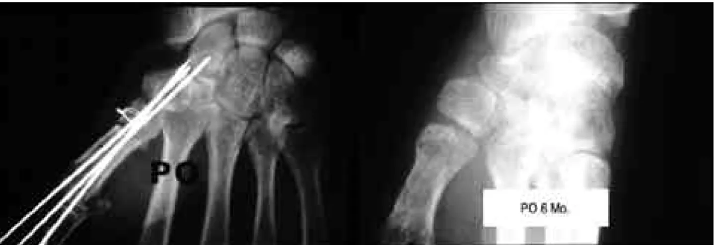 Fig. 4. Thumb ligamentoplasty and corrective osteotomy was done (PO). Radiogrph of the thumb TMC joints at 6 months.