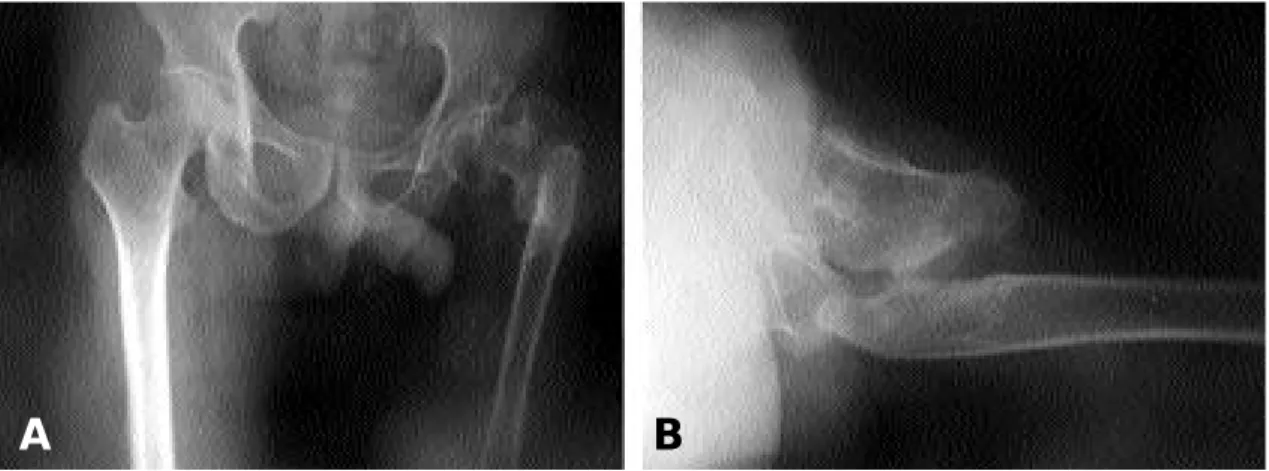 Fig. 1. Both hip AP A. and cross table lateral B. views show non-union of proximal femur with mal-alignment, short- short-ening, and dysplasia, coxa vara.