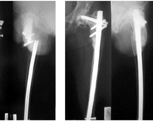 Fig. 5. Bone union was obtained at 6 months after nail change with secondary graft.