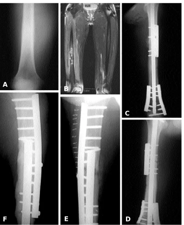 Fig. 2A-F. A 19-year-old boy had osteoblastic osteosarcoma on the shaft of femur.  A 