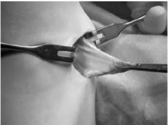 Fig. 1. Reversed L-shape incision to the sartorius fascia was made and the flap was reflected.