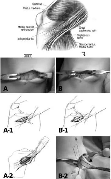 Fig. 2. Comparison of classic with modified hamstring tendon harvest. In the classic method (A), saphenous nerve is close to the incision (A-1) and possibility of tendon split is existed (A-2)