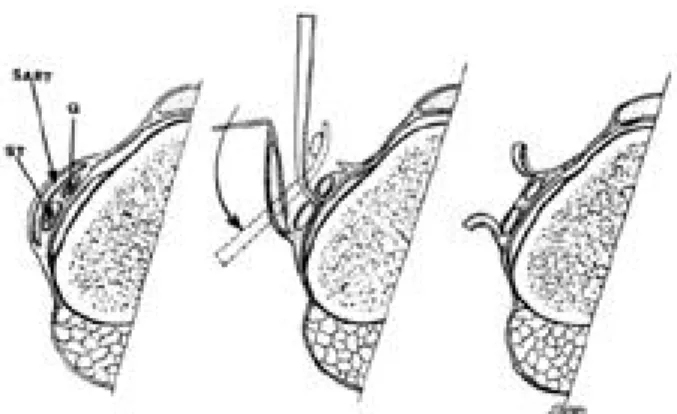 Fig. 3. Cross-sectional illustration demonstrating the relation- relation-ship between the sartorius and the semitendinosus and gracilis tendons before dissection (left)