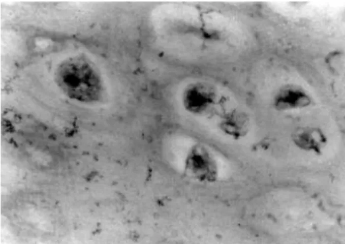 Fig. 1. Photomicrograph of immunohistochemical staining for p53 in chondrosarcoma (Grade 4+ original magnification ×200).