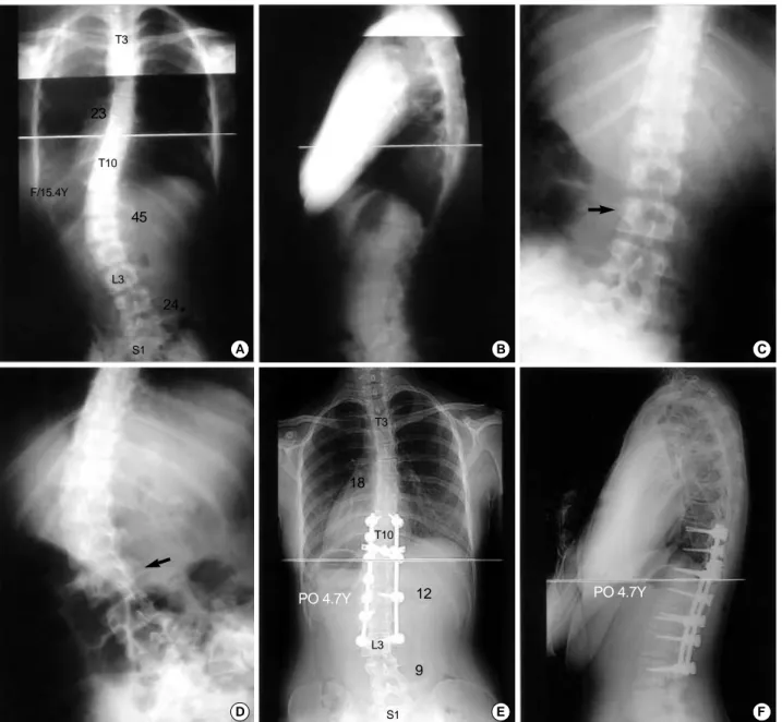 Fig. 2. Case 5. 15.4-year-old girl. (A, B) Preoperative anteroposterior and lateral radiograph showed thoracolumbar curve of 45 ° and non- non-structural thoracic curve of 23 ° and lumbosacral curve of 24 ° 