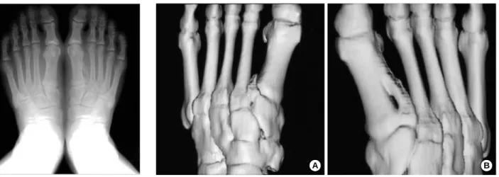 Fig. 3. Preoperative bone scan showing a hot spot on the right foot between the 1st and 2nd intermetatarsal bones.
