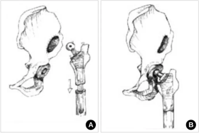 Fig. 3. (A) The true femoral component was inserted into the femur.