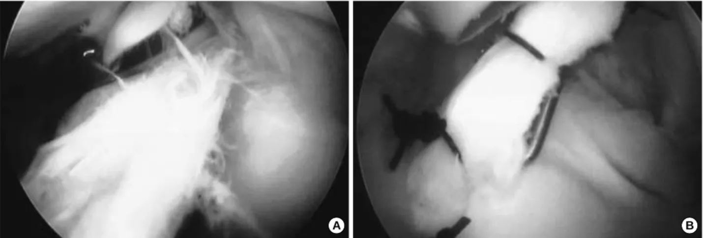 Fig. 3. (A) The type IV SLAP lesion has a spilt superior labrum that continues into the biceps tendon