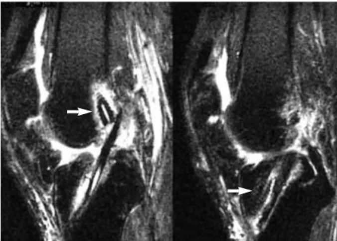 Fig. 2. MRI finding of the knee of Figure 1, 6 month after operation.