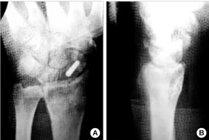 Fig. 2. Postoperative AP (A) and lateral (B) roentgenograms showing the fractures fixed by Acutrak screw.
