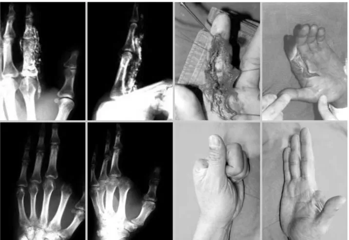 Fig. 3. Fourty-seven year old man injured by a paint gun. Paint invaded along the neurovascular bundle of the finger