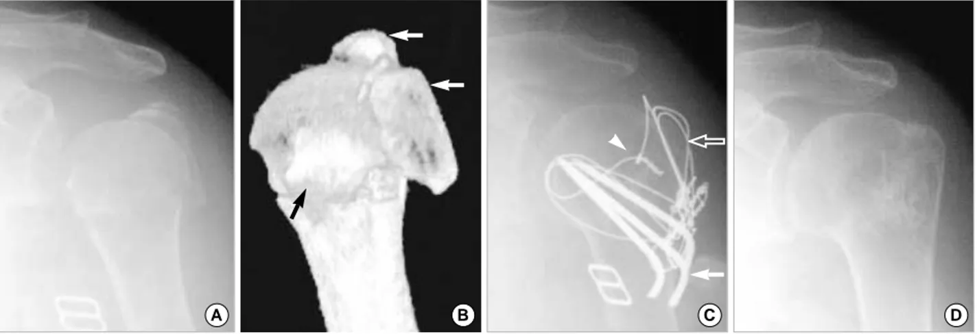 Fig. 1. (A) Initial anteroposterior view of a case of three-part fracture of the proximal humerus by Neer’s classification, with valgus impacted fracture pattern