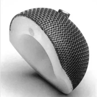 Fig. 1. This photographs shows a nonmodular press fit cup with 4 layers of titanium wire mesh (SULMESH) coating (Sulzer, Baar, Switzerland)