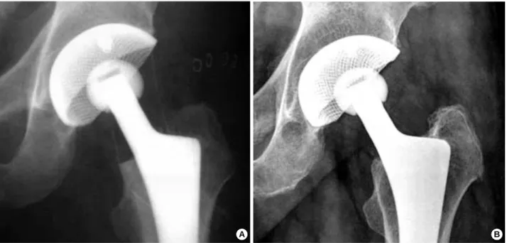 Fig. 2. Postoperative radiograph showing a press-fit acetabular compomemt with appropriate position (A)