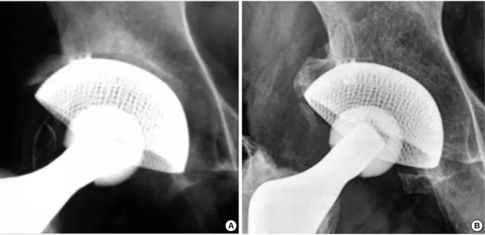 Fig. 4. The  photograph shows a bony ingrowth through the layers of wire mesh when well fixed acetabular component was revised due to chronic unreduced dislocation and periprosthetic fracture.