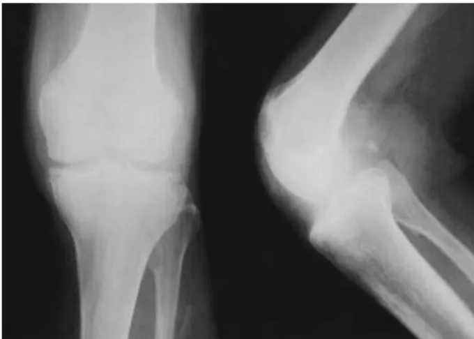 Fig. 2. Plain anteroposterior and lateral roentgenograms show the absence of a patella.