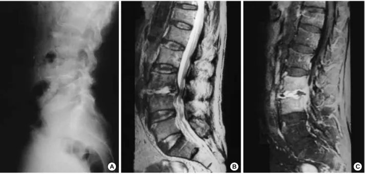 Fig. 1. Plain radiograph and magnetic resonance image of the 58 year-old male patient