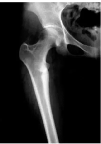 Fig. 7. Postoperative roentgenogram  show-ing union and no  evi-dence of recurrence.