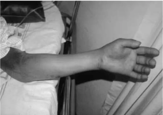 Fig. 1. Preoperative photograph demonstrating the a severely swollen and tense forearm
