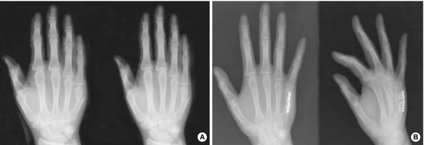 Fig. 2. (A) Preoperative radiograph of a 31-year-old male patient with neglected 5th metacarpal fracture shows dorsal angulation and shortening of the fractured 5th metacarpal bone