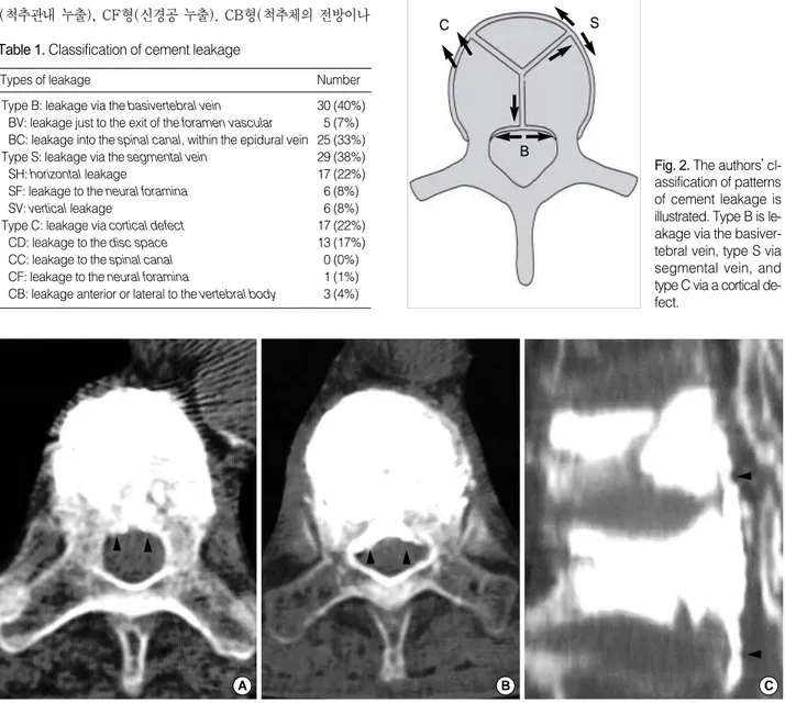 Fig. 3. CT scans of type B leaks are shown. (A) Type BV leakage. (B) Type BC leakage. Cement distribution of type BC leakage is relatively symmetrical, and cement does not occupy more than 1/3 of the spinal canal