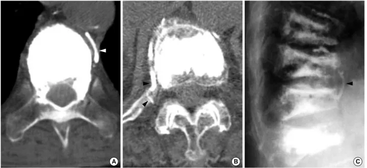 Fig. 4. CT scans and a lateral radiograph of type S leaks. (A) Type SH leakage. (B) Type SF leakage