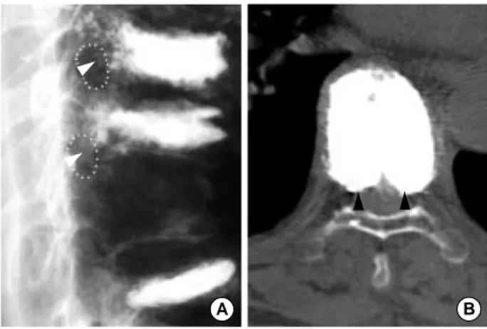 Fig. 9. Lateral radiograph and CT scan of leakage into the spinal canal. On the lateral radiograph (A), cement seems to be in the vertebral body just anterior to the pedicles (Zone IV), but the CT scan (B) reveals that it is a type B leakage.