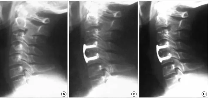 Fig. 4. A 42-year-old female patient with posterior neck pain and left upper extremity weakness