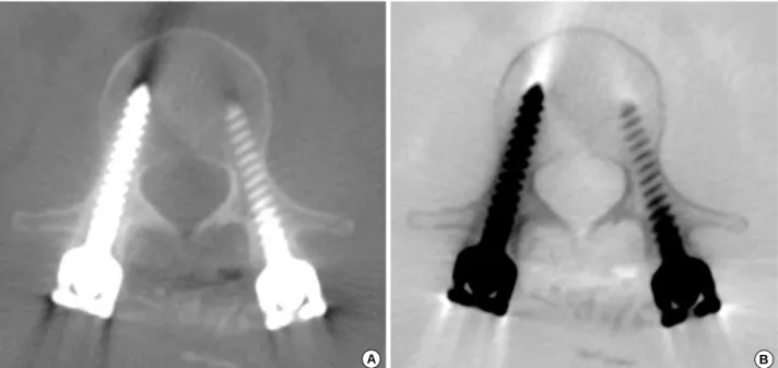 Fig. 1. An image with a window range of -2,000 to +3,000 (A) and its inverted image (B).