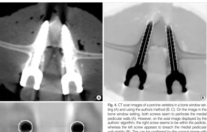 Fig. 4. CT scan images of a porcine vertebra in a bone window set- set-ting (A) and using the authors method (B, C)