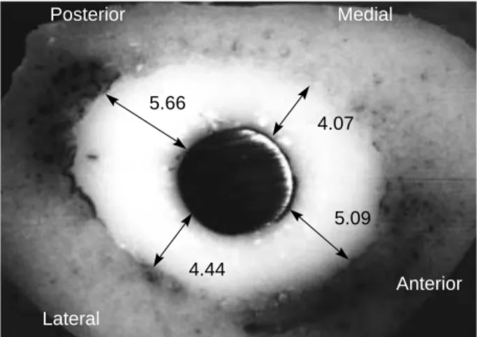 Table 1. The cement thickness around a retrieved femoral stem in the transverse section