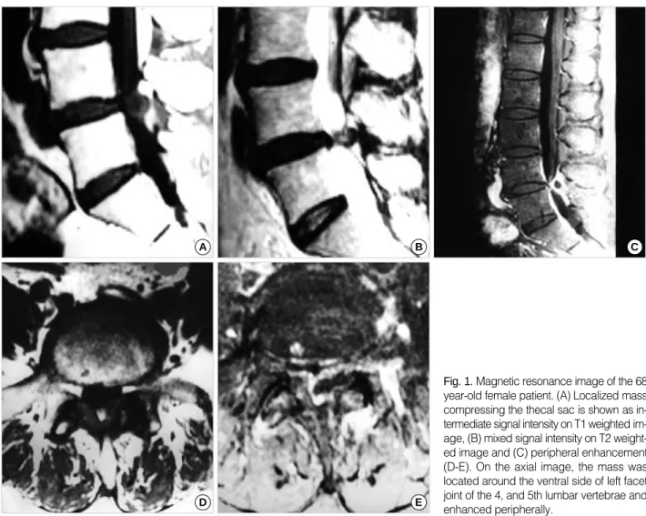 Fig. 1. Magnetic resonance image of the 68 year-old female patient. (A) Localized mass compressing the thecal sac is shown as  in-termediate signal intensity on T1 weighted  im-age, (B) mixed signal intensity on T2  weight-ed image and (C) peripheral enhan