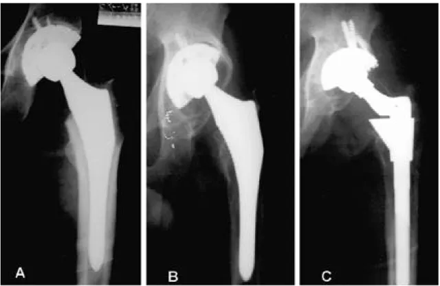Fig. 4. Kaplan-Meier accumulative survival curve for the acetabular cup using revision as the endpoint.