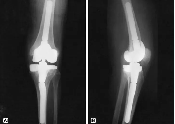 FIGURE 2. two years after staged reimplantation.