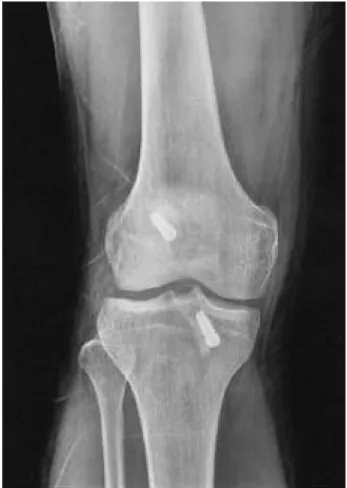 FIGURE 3. This shows bone-patellar tendon-bone(BPTB) graft after preparation.