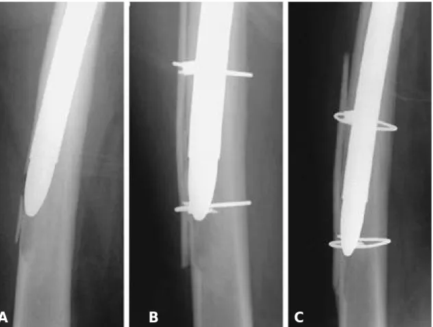 Fig. 3. (A) Cortical perforation during the insertion of straight femoral stem is found during operation