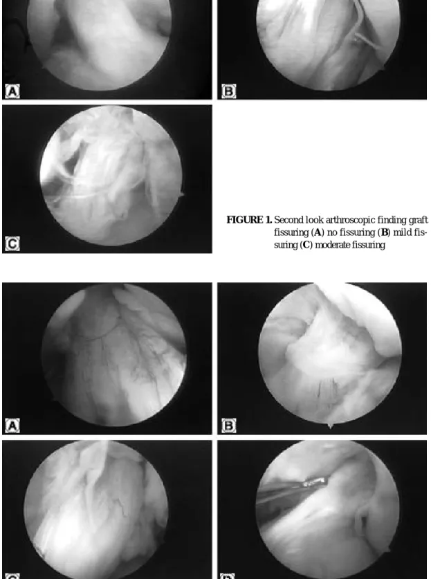 FIGURE 1. Second look arthroscopic finding graft fissuring (A) no fissuring (B) mild  fis-suring (C) moderate fisfis-suring