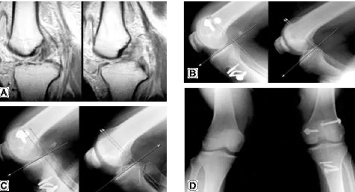 FIGURE 1. Radiographs of a 34-year-old man with knee dislocation, A: Preoperative MRI shows complete ACL and PCL tear, B: